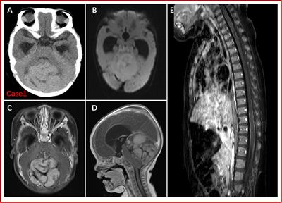 Congenital medulloblastoma in two brothers with SUFU-mutated Gorlin-Goltz syndrome: Case reports and literature review